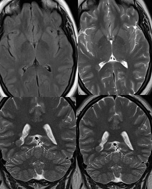 Heterotopic Gray Matter